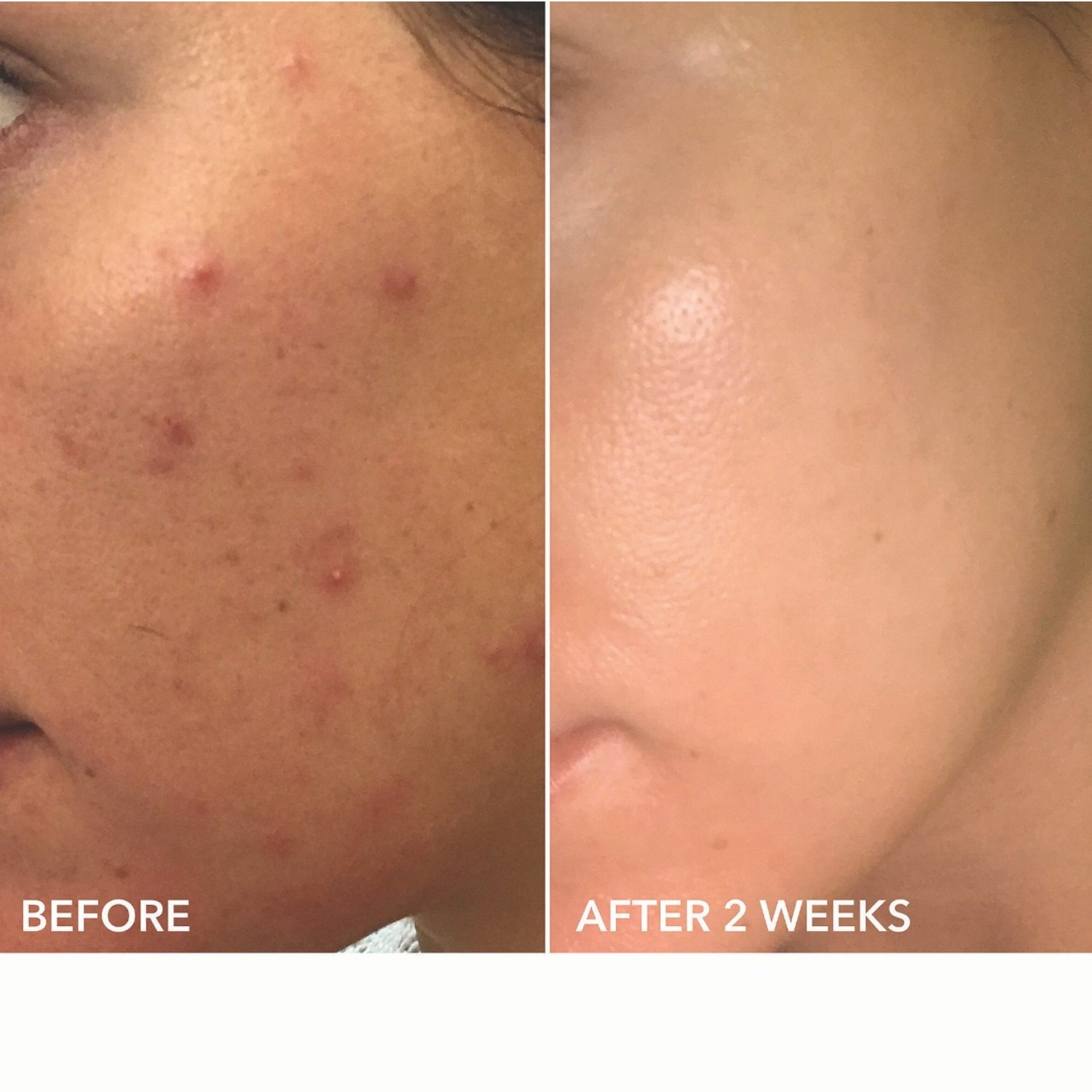ALPHA BETA EXTRA STRENGTH DAILY PEEL  (ALMOHADILLAS EXFOLIANTES DIARIAS EXTRAFUERTES)